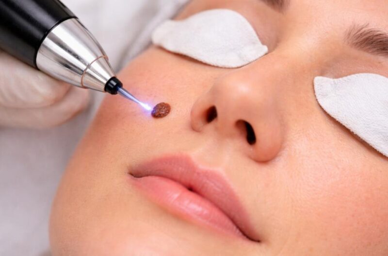 Tiến hành loại bỏ nốt ruồi bằng công nghệ plasma