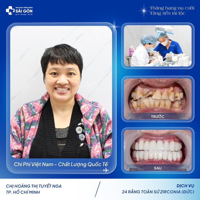 Hình ảnh khách hàng bọc răng sứ thẩm mỹ tại Nha Khoa Trồng Răng Sài Gòn