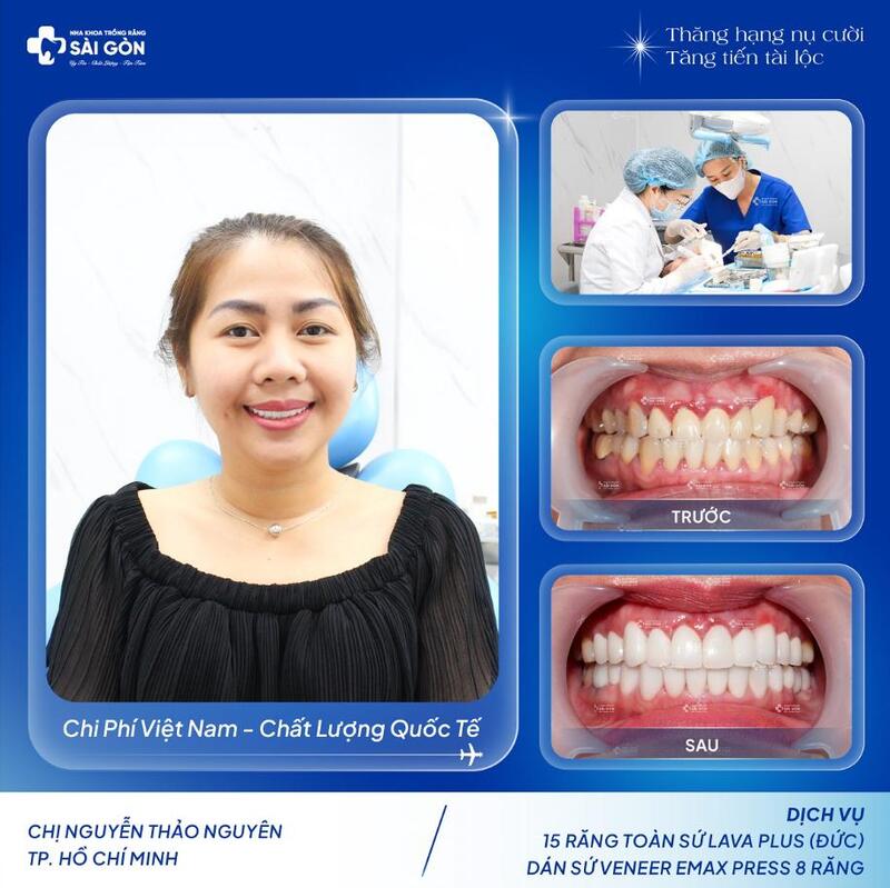 Hình ảnh khách hàng dán sứ Veneer tại Nha Khoa Trồng Răng Sài Gòn