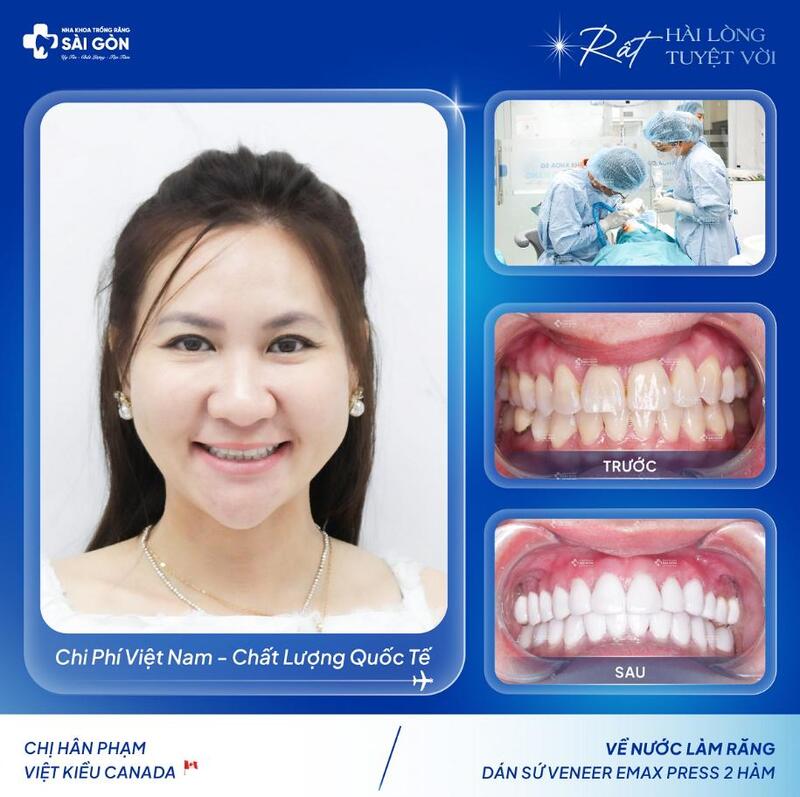 Hình ảnh khách hàng dán sứ Veneer tại Nha Khoa Trồng Răng Sài Gòn
